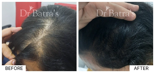 Hair Falling Treatment